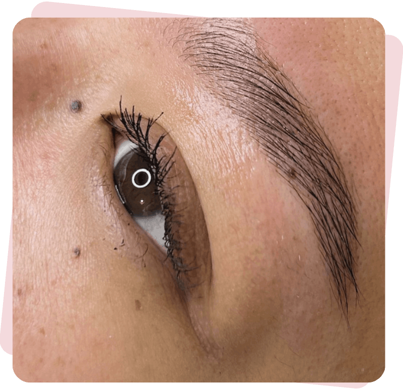 Browlift